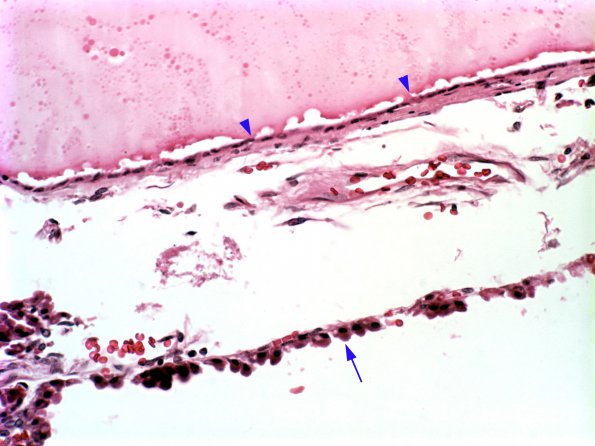 9A3 Cyst, Colloid (Case 9) 1