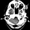 Cyst - Dermoid