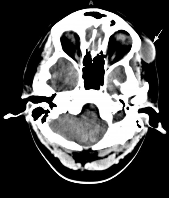 1A Cyst, dermoid (Case 1) CT