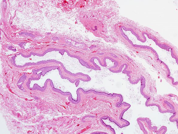 1B1 Cyst, dermoid type (Case 1) H&E 4