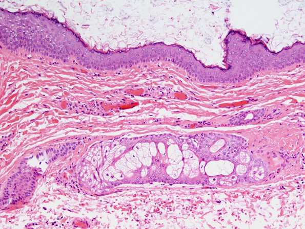 1B2 Cyst, dermoid type (Case 1) H&E 3