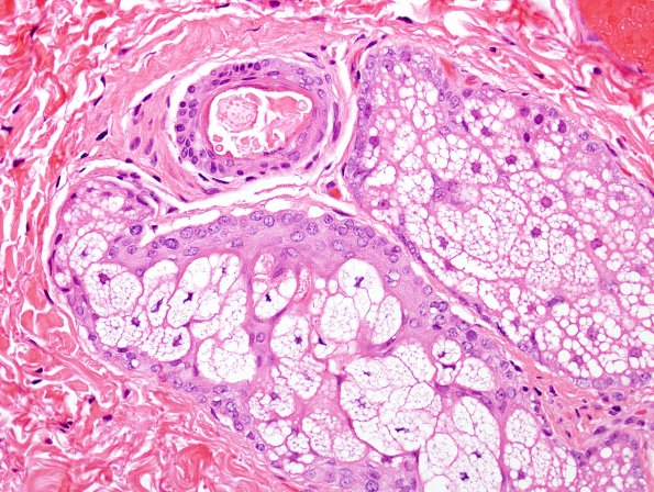 1B3 Cyst, dermoid type (Case 1) H&E 2