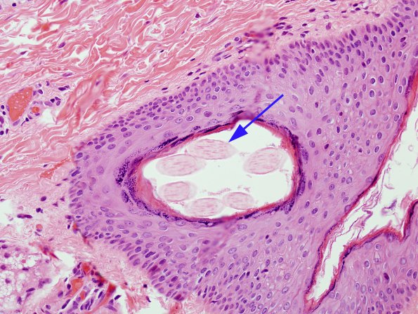 1B4 Cyst, dermoid type (Case 1) H&E 1