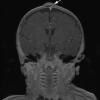 2A Cyst, dermoid, skull (Case 2) T1 W