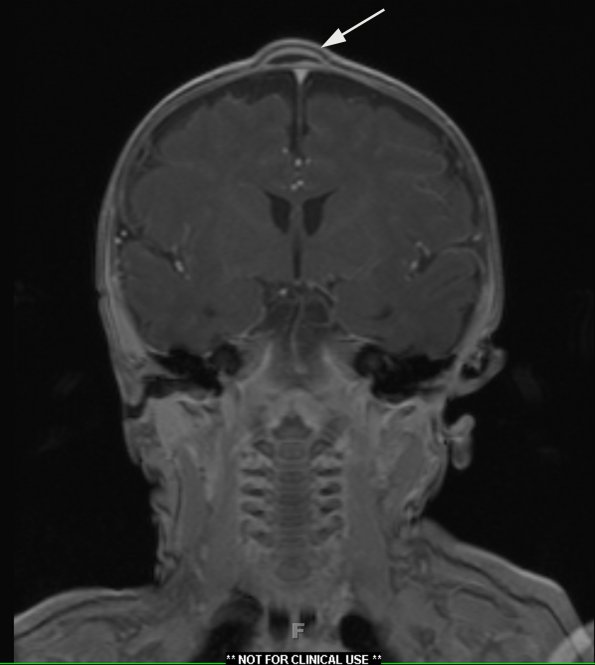 2A Cyst, dermoid, skull (Case 2) T1 W