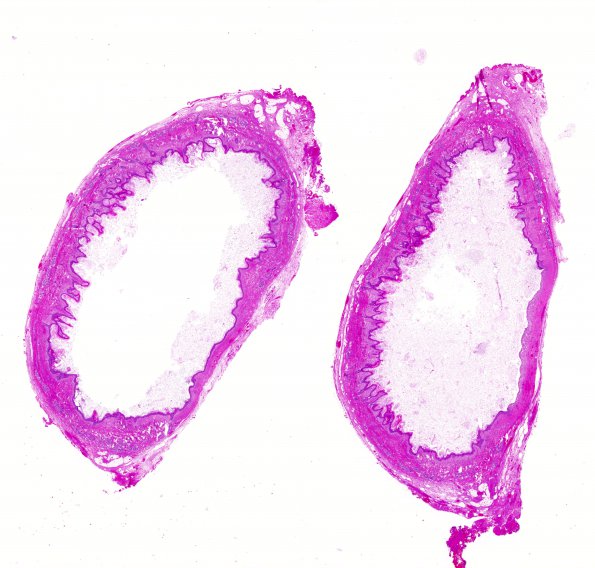 2B1 Cyst, dermoid, skull (Case 2) H&E whole mount