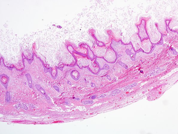 2B2 Cyst, dermoid, skull (Case 2) H&E 1