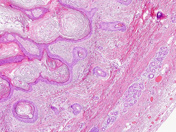 2B3 Cyst, dermoid, skull (Case 2) H&E 2