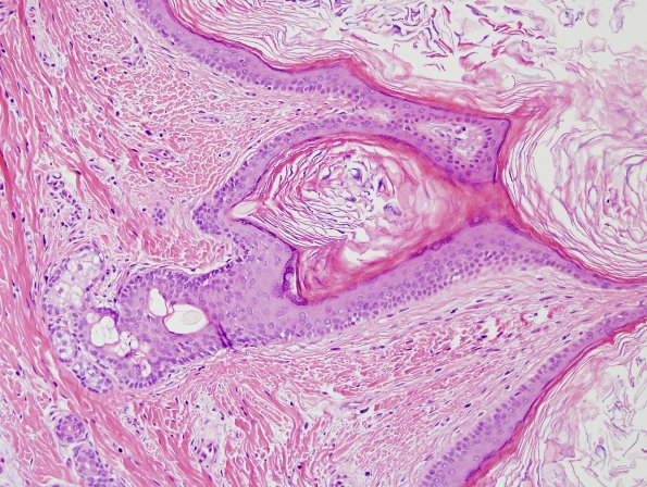 2B4 Cyst, dermoid, skull (Case 2) H&E 8