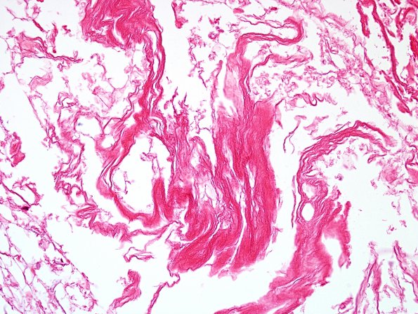 2B5 Cyst, dermoid, ruptured, rxn (Case 2) H&E 10