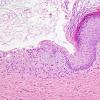 2B6 Cyst, dermoid, skull (Case 2) H&E 5