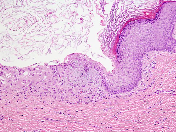 2B6 Cyst, dermoid, skull (Case 2) H&E 5