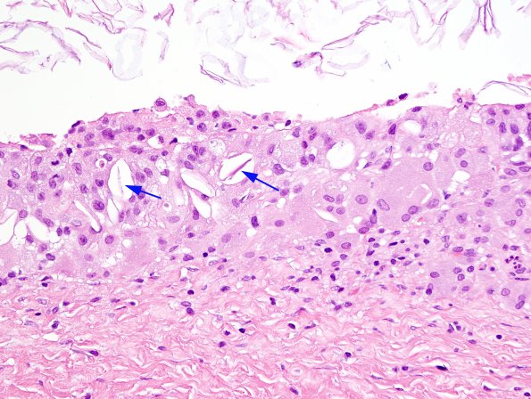 2B7 Cyst, dermoid, skull (Case 2) H&E 6