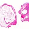 3A1 Cyst, dermoid, ruptured, rxn (Case 3) H&E whole mount