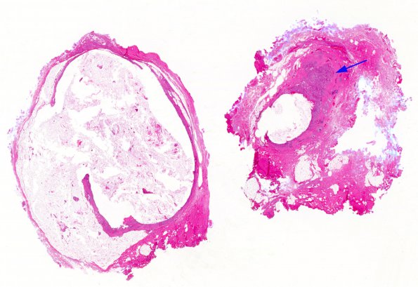 3A1 Cyst, dermoid, ruptured, rxn (Case 3) H&E whole mount