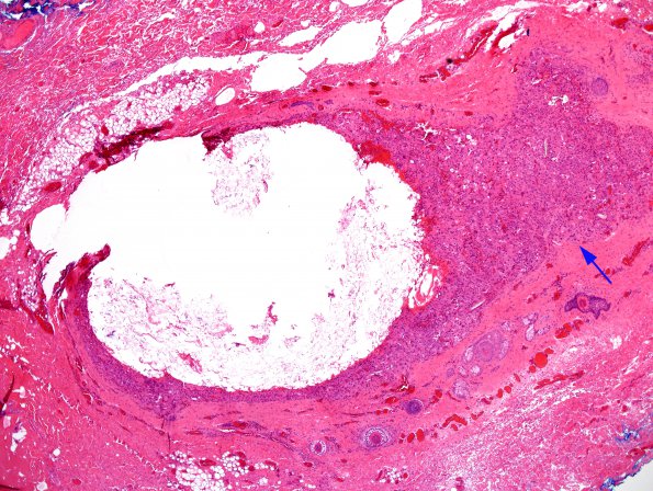 3A2 Cyst, dermoid, ruptured, rxn (Case 3) H&E 11