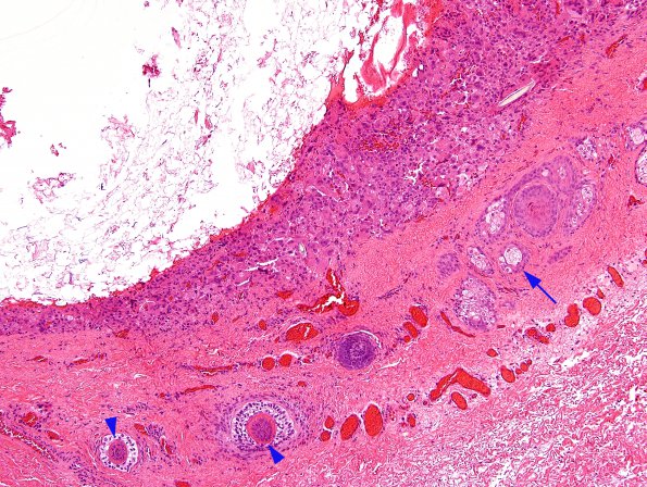 3A3 Cyst, dermoid, ruptured, rxn (Case 3) H&E 12