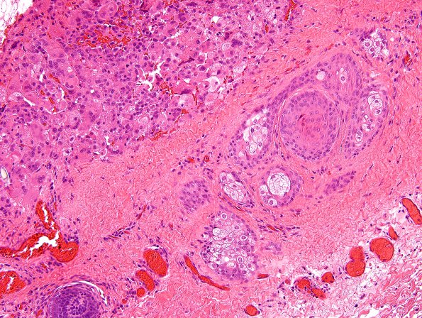 3A4 Cyst, dermoid, ruptured, rxn (Case 3) H&E 3