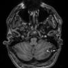 5A1 Cyst, Dermoid (Case 5) T1 MPRAGE no contrast 2 copy - Copy