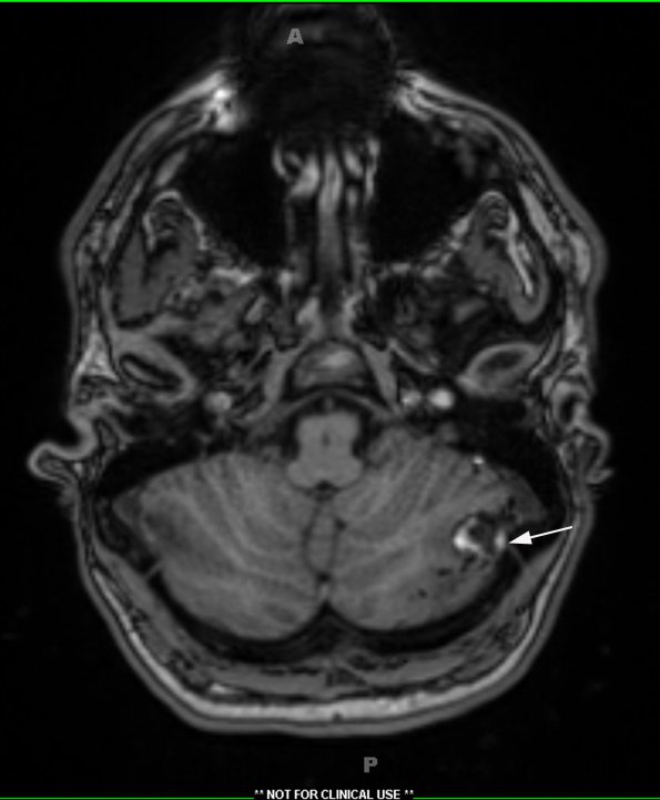 5A1 Cyst, Dermoid (Case 5) T1 MPRAGE no contrast 2 copy - Copy