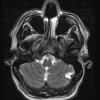 5A2 Cyst, Dermoid (Case 5) T2 no contrast - Copy