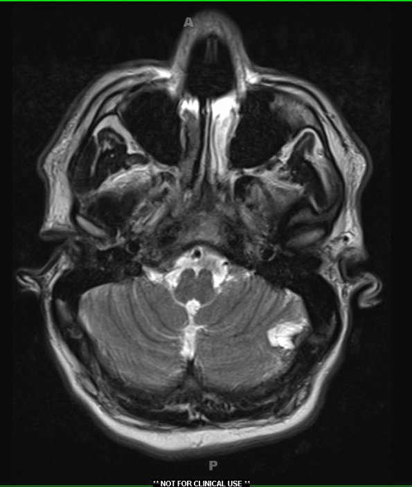 5A2 Cyst, Dermoid (Case 5) T2 no contrast - Copy