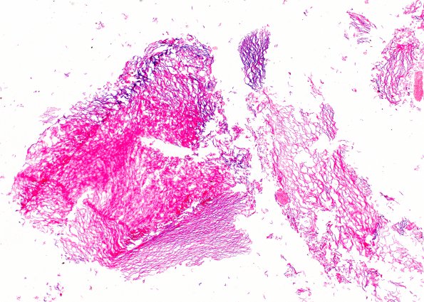 5B1 Cyst, dermoid (Case 5) H&E 1