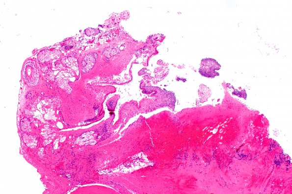 5B2 Cyst, dermoid (Case 5) H&E 2