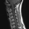 10A1 Cyst, neurenteric (Case 10) T1 with contrast copy - Copy