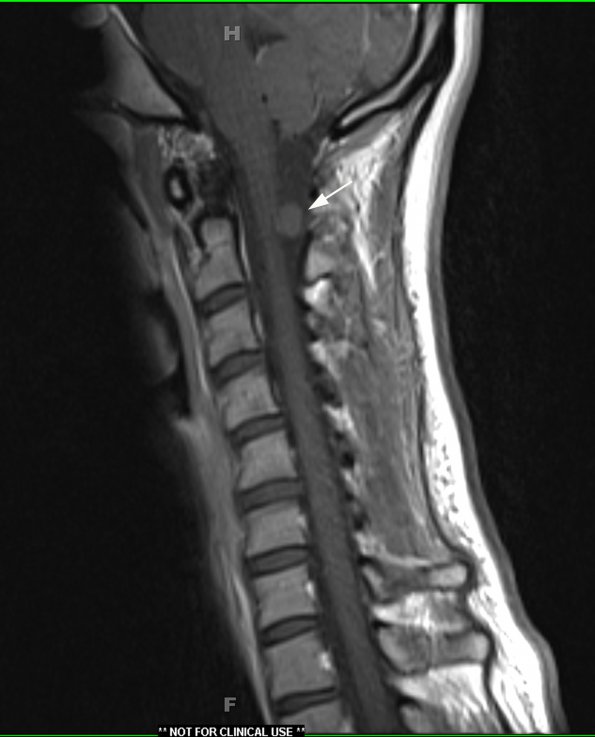 10A1 Cyst, neurenteric (Case 10) T1 with contrast copy - Copy