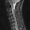 10A2 Cyst, neurenteric (Case 10) STIR 1 no contrast - Copy