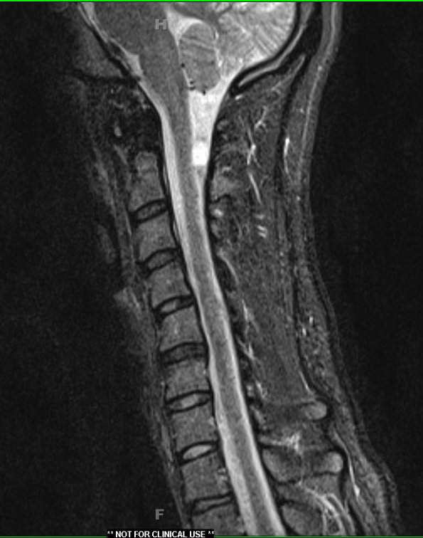 10A2 Cyst, neurenteric (Case 10) STIR 1 no contrast - Copy