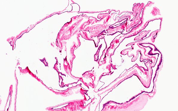 10B1 Cyst, Neurenteric (Case 10) H&E 4X 1