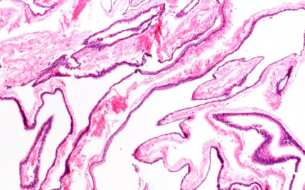 10B2 Cyst, Neurenteric (Case 10) H&E 10X 1