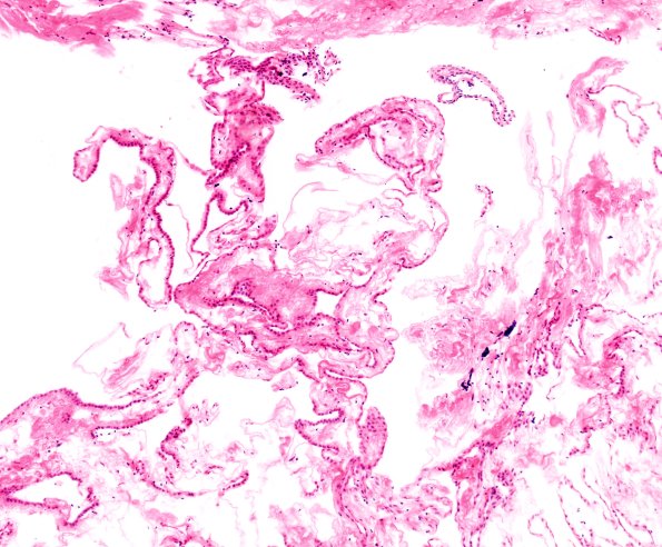 11A1 Cyst, endodermal, (Case 11A) H&E 10X