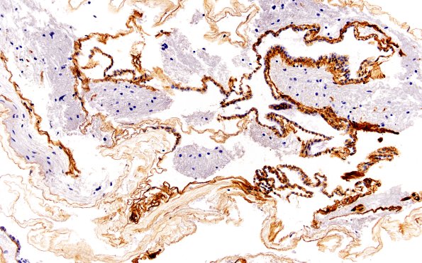 11A8 Cyst, endodermal, (Case 11A) Coll IV 20X