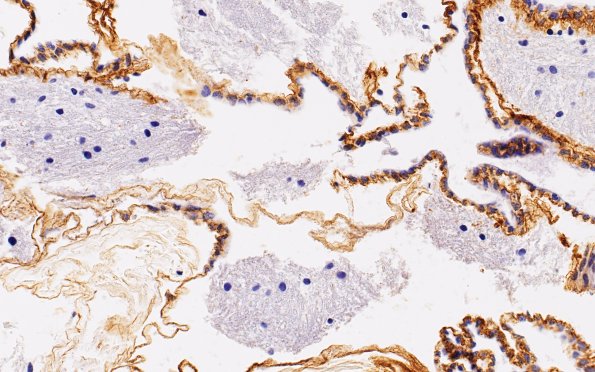 11A9 Cyst, endodermal, (Case 11A) Coll IV 40X