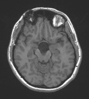 11B2 Cyst, endodermal, (Case 11B) T1noC A - Copy