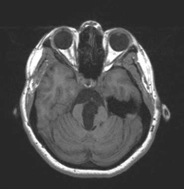 11B3 Cyst, endodermal, (Case 11B) T1noC 2A - Copy