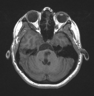 11B4 Cyst, endodermal, (Case 11B) T1noC 3a - Copy