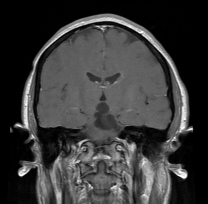 11B5 Cyst, endodermal, (Case 11B) T1W Cor a - Copy