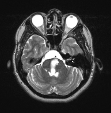 11B7 Cyst, endodermal, (Case 11B) T2W - Copy