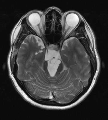 11B8 Cyst, endodermal, (Case 11B) T2 FRFSE W - Copy