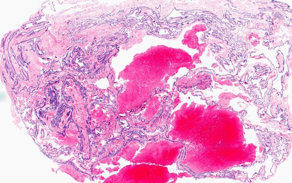 11C1 Cyst, endodermal, (Case 11B) H&E 4X