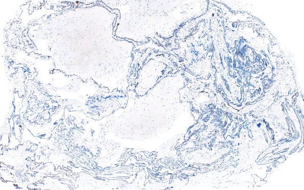 11D1 Cyst, endodermal, (Case 11B) EMA 4X