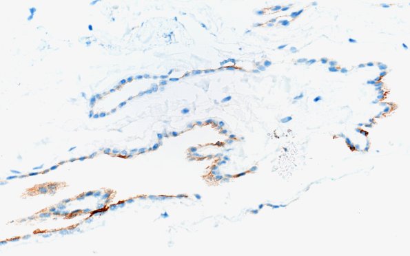 11D2 Cyst, endodermal, (Case 11B) EMA 40X (2)