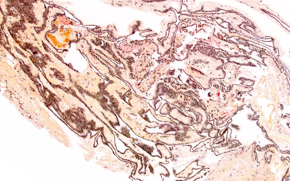 11G1 Cyst, endodermal, (Case 11B) Mucicarmine 10X