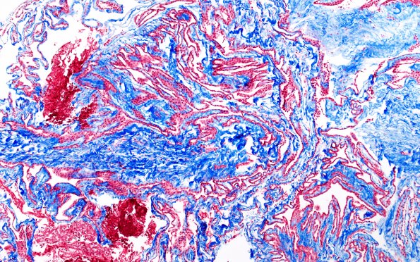 11H2 Cyst, endodermal (Case 11B) Trichrome 10X