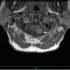 Cyst - Endodermal (aka Neurenteric, Enterogenous)