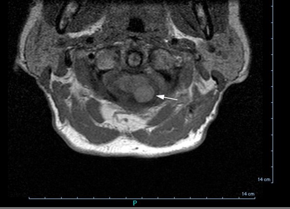 1A1 Cyst, neurenteric (Case 1) T1